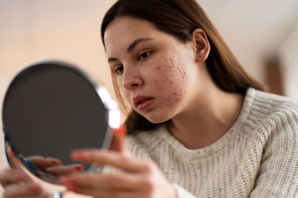 Best Doctors for Acne Treatment In Raipur