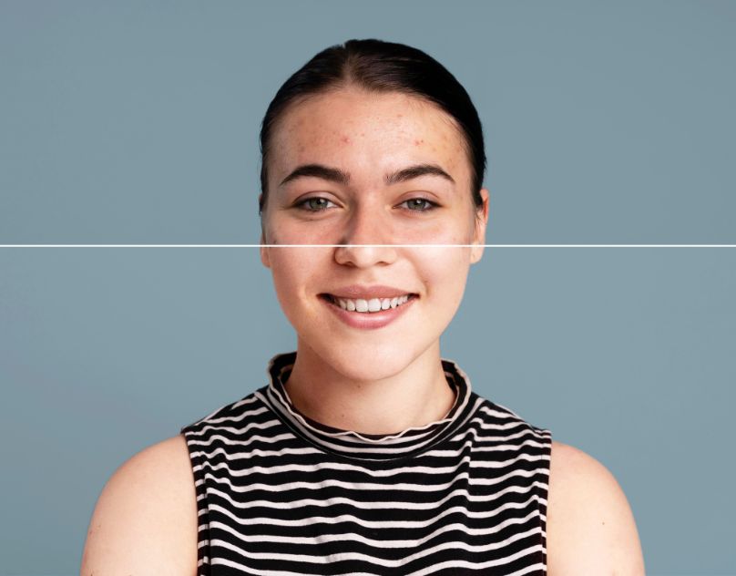 Best Doctors for Acne Treatment in Raipur