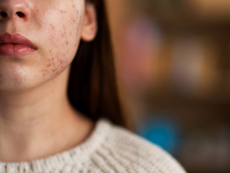 acne treatment in Raipur