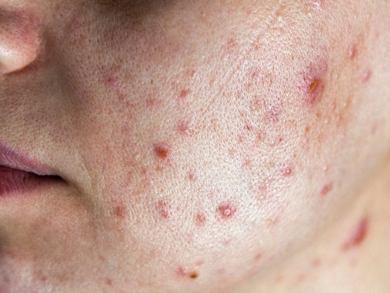 acne treatment in Raipur
