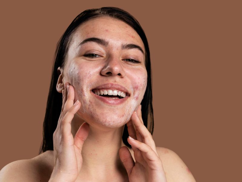 acne treatment in Raipur